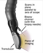 Linear EUS