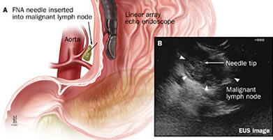 Fine needle aspiration