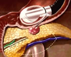 FNA