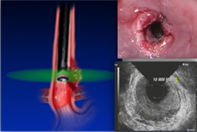 linear EUS