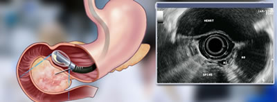 Pancreatobiliary Masses