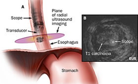 Radial EUS