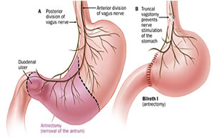 Surgical Antrectomy