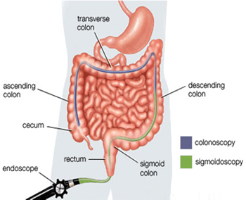 colonoscopy