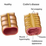 crohn's